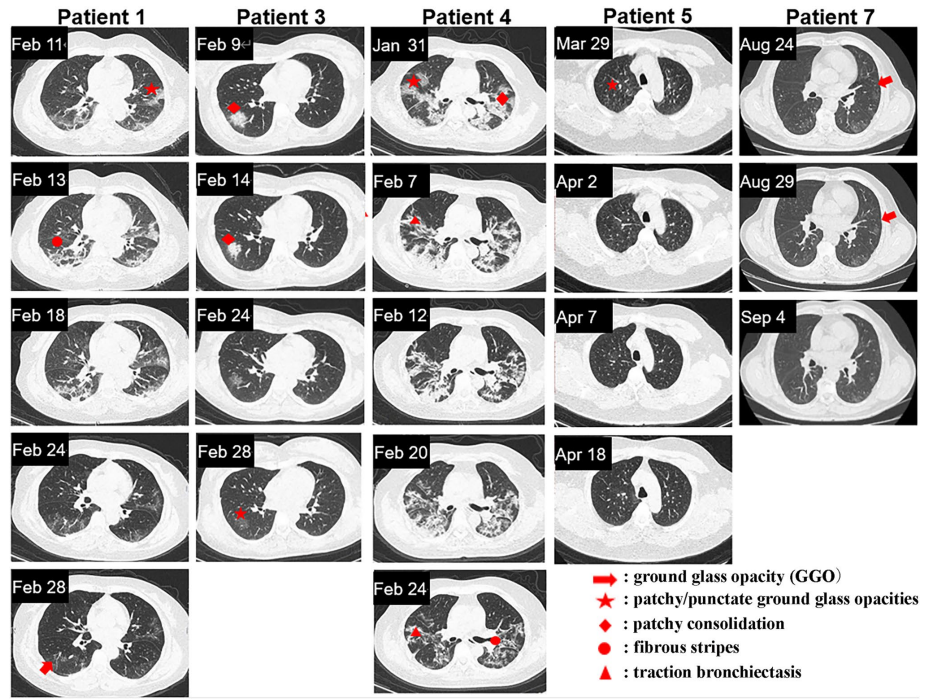 自體脂肪干細(xì)胞儲存 自體脂肪干細(xì)胞儲存
