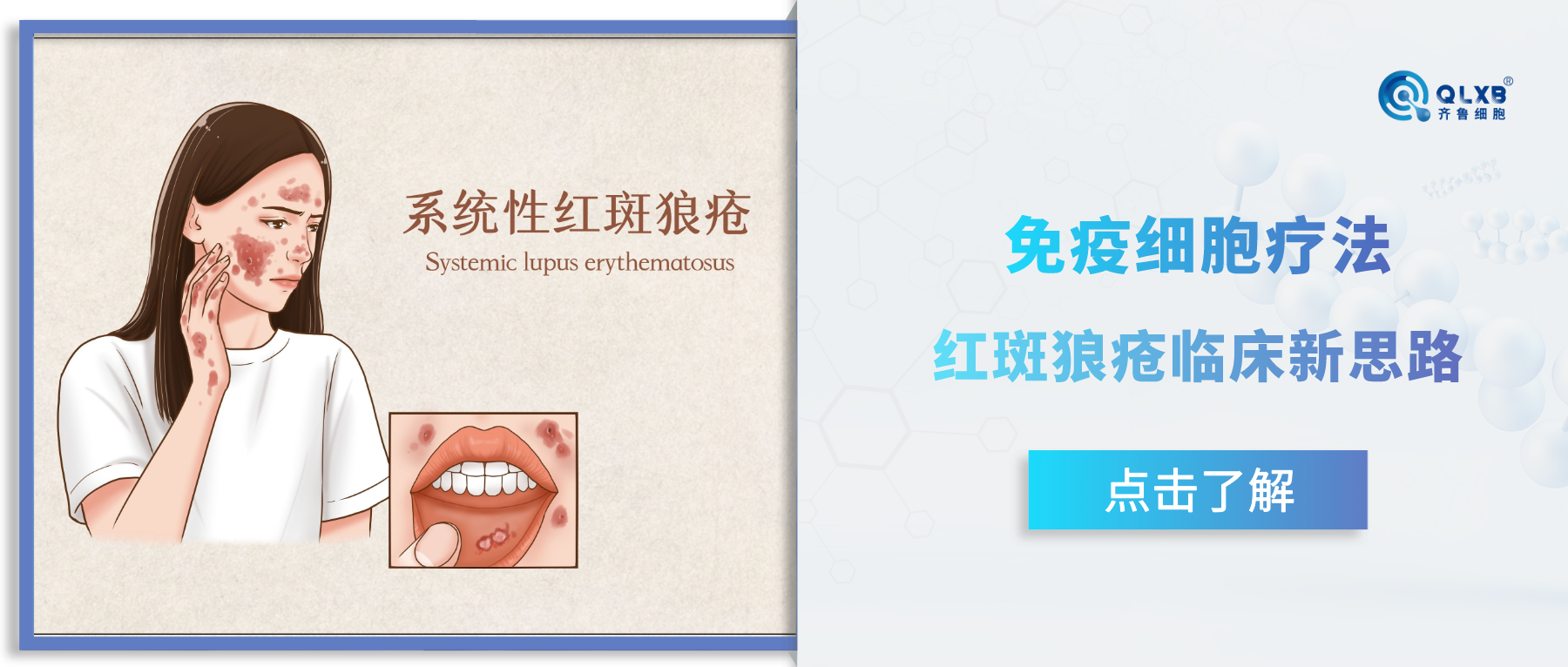 免疫細胞療法：紅斑狼瘡的臨床新思路