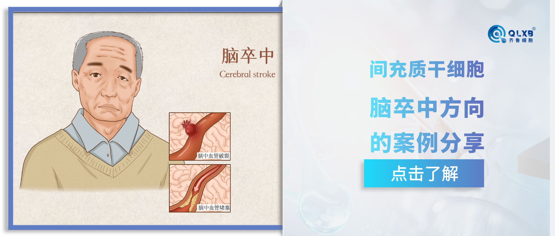 案例分享 | 干細(xì)胞在腦卒中臨床應(yīng)用研究中效果出色與否?案例給了答案 案例分享 | 干細(xì)胞在腦卒中臨床應(yīng)用研究中效果出色與否?案例給了答案