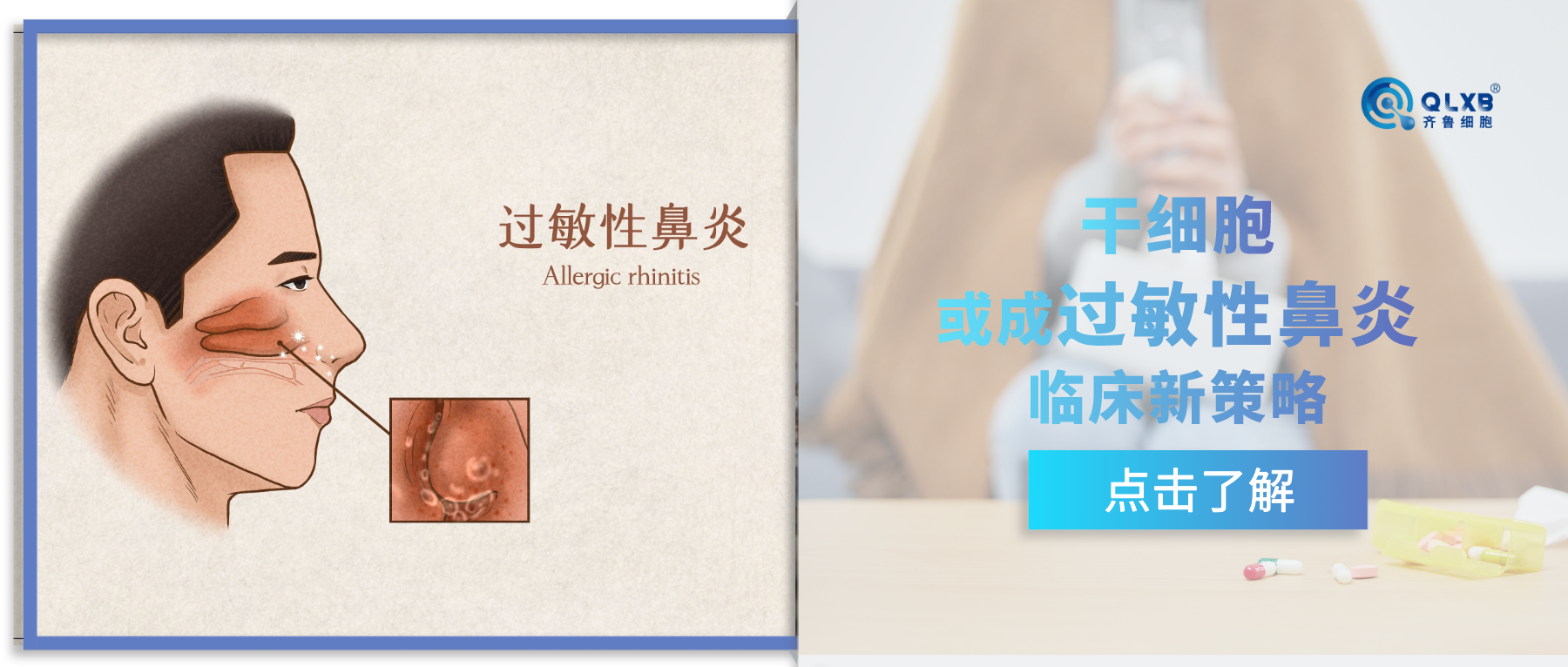 噴嚏不斷，眼睛癢？馬上又到該病高發期，干細胞或成為過敏性鼻炎臨床新策略