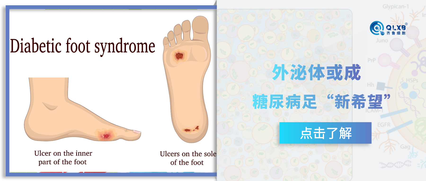 外泌體或成為“對抗”糖尿病足新希望