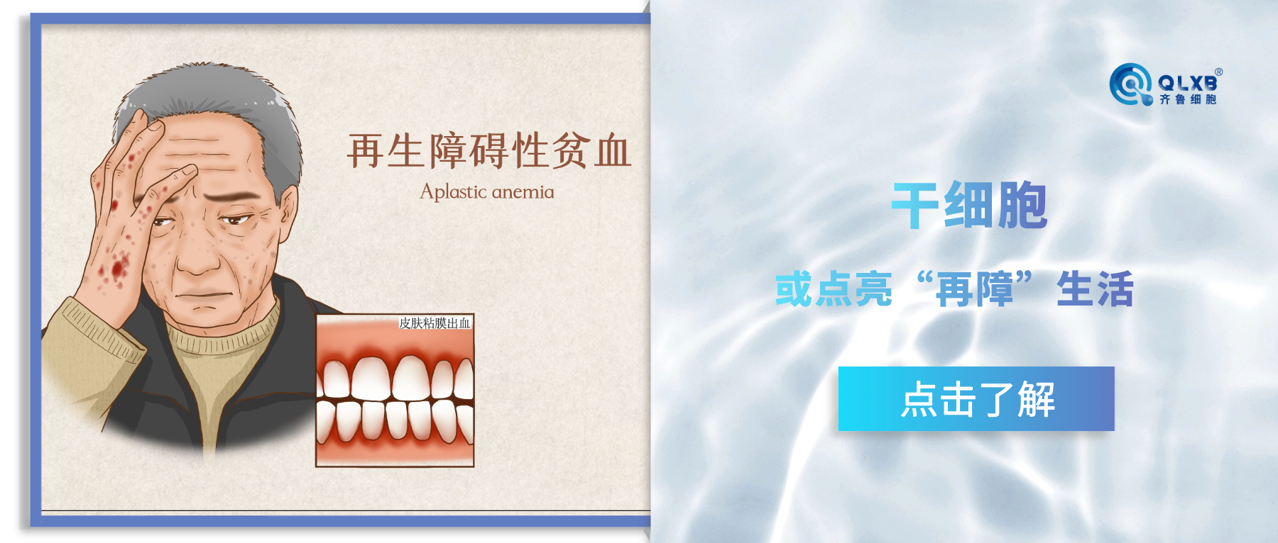 案例分享 | 干細(xì)胞“打破”再生障礙性貧血困境 案例分享 | 干細(xì)胞“打破”再生障礙性貧血困境