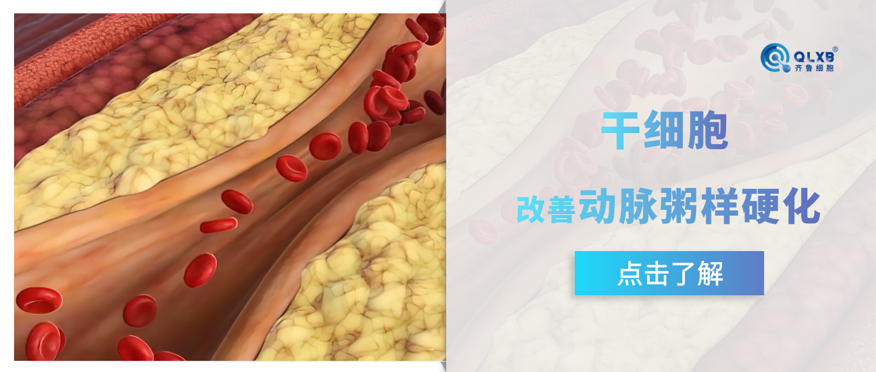 案例分享 | 干細胞或可改善動脈粥樣硬化，守護心血管健康