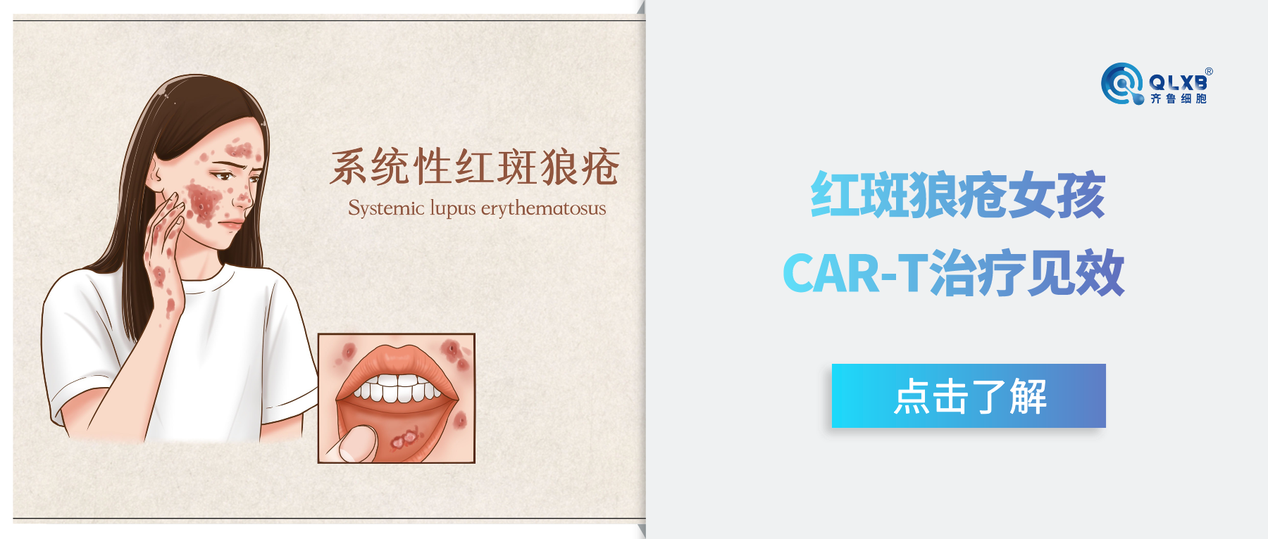 CAR-T再受關(guān)注!國內(nèi)首例接受該療法的12歲紅斑狼瘡女孩已出院 CAR-T再受關(guān)注!國內(nèi)首例接受該療法的12歲紅斑狼瘡女孩已出院