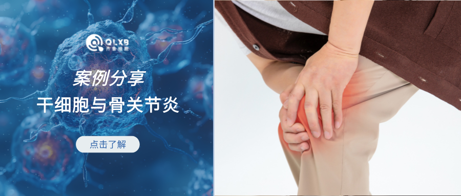 案例分享 | 干細(xì)胞針對(duì)骨關(guān)節(jié)炎，610名患者證實(shí)有效