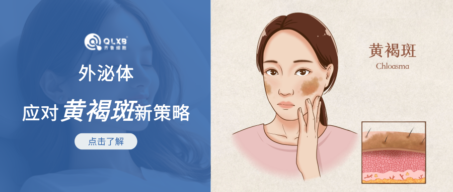 令女性朋友“頭疼”的黃褐斑，外泌體或可成為應對新策略