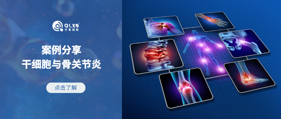 案例分享 | 干細胞應對骨關節炎，75%的受試者疼痛明顯減輕