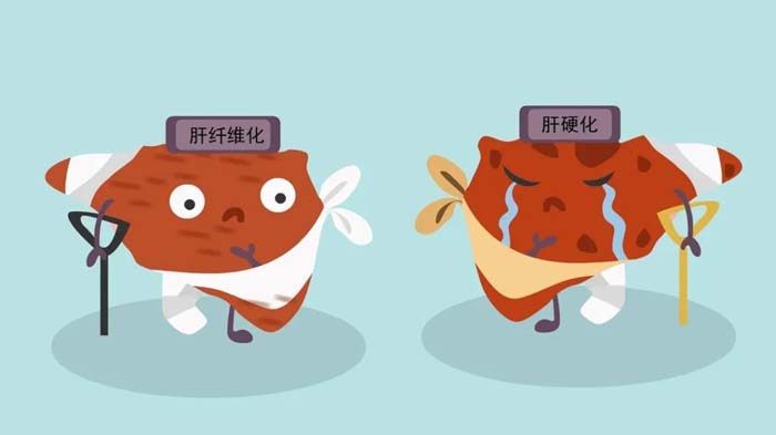 干細胞治療肝硬化，讓肝“軟回來”