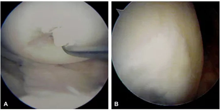 自體脂肪干細胞儲存 自體脂肪干細胞儲存