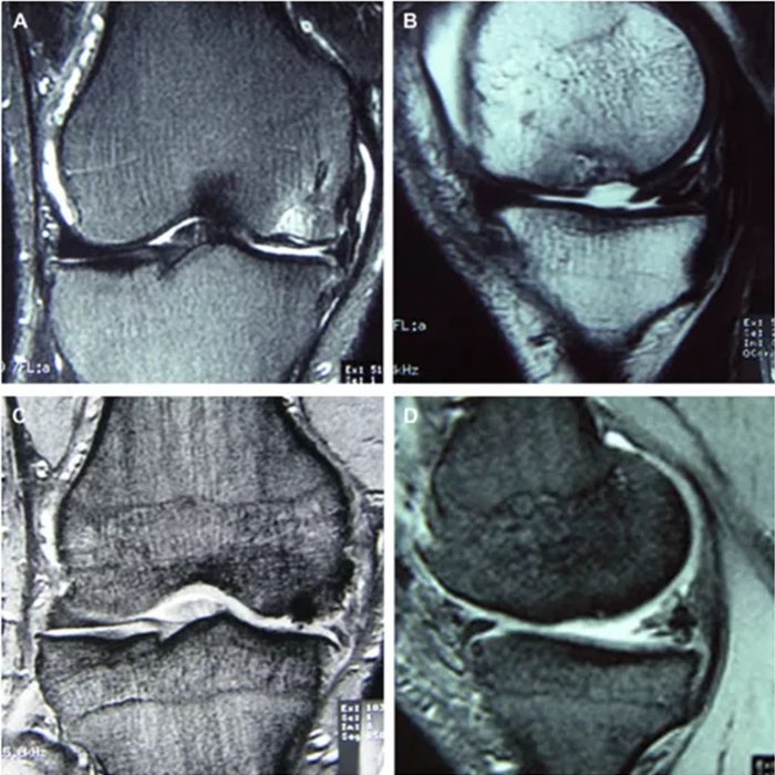自體脂肪干細胞儲存 自體脂肪干細胞儲存